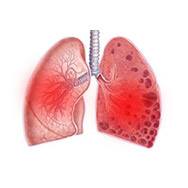 Заболевания дыхательных путей (ангина, пневмония и др.)