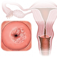 Полипы эндометрия и кондиоломы