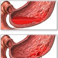 Желудочно-кишечное кровотечение