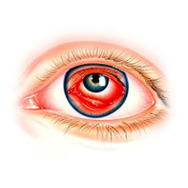 Воспаление глаза